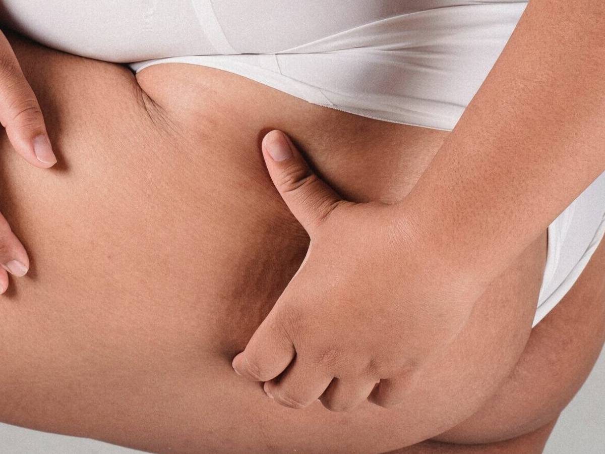 Massaggi linfodrenanti e lipedema: utilità e limiti